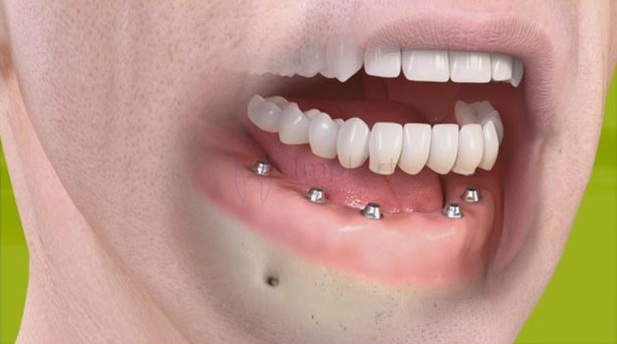 Implantes dentários parciais ou completos