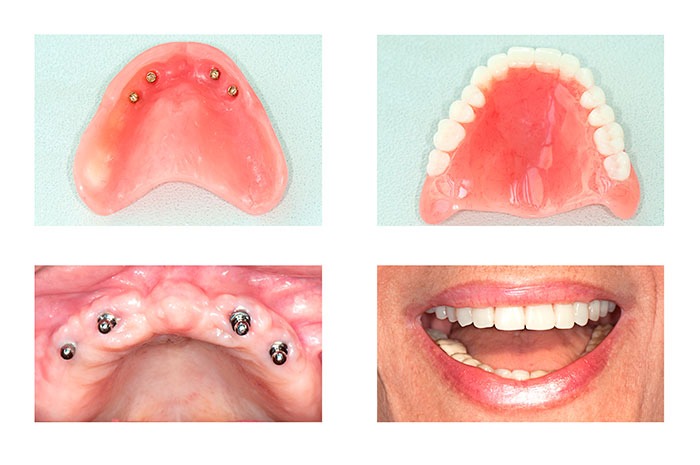 Implantes dentários parciais ou completos