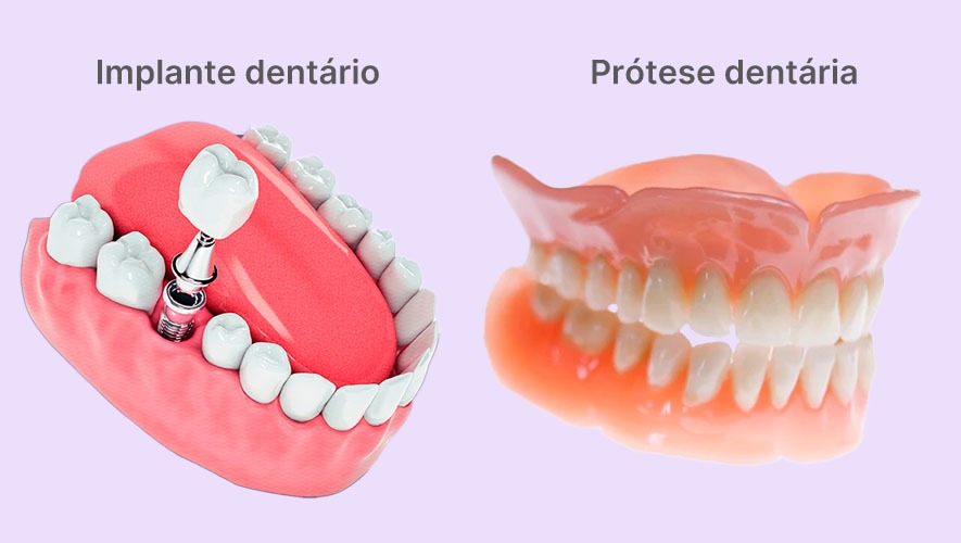 Implantes dentários parciais ou completos